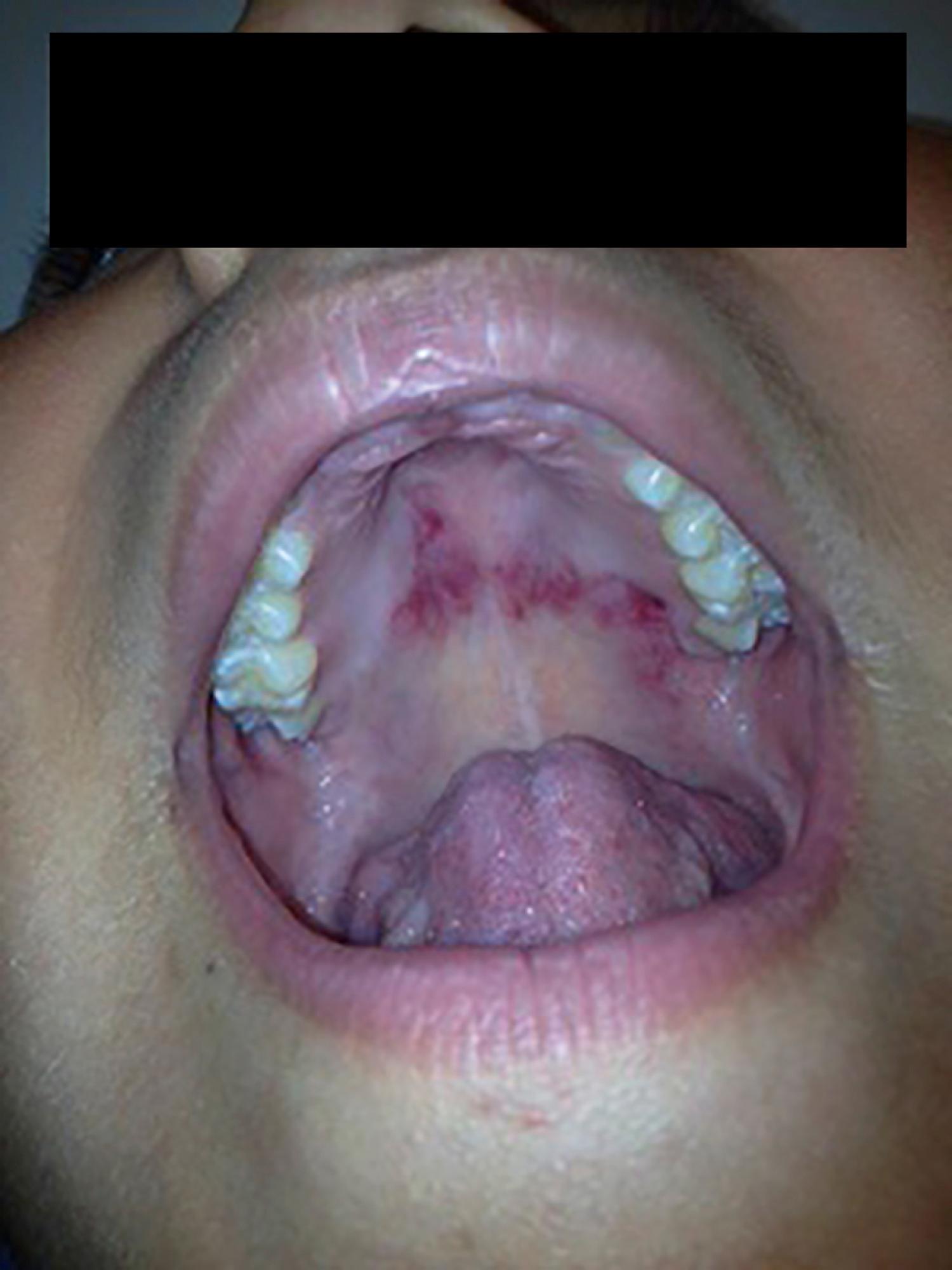 Fig. 23.17, Mucocutaneous ulcerations of acute systemic lupus erythematosus. A shallow, painless, erythematous ulceration with an irregular margin is seen on the hard palate.