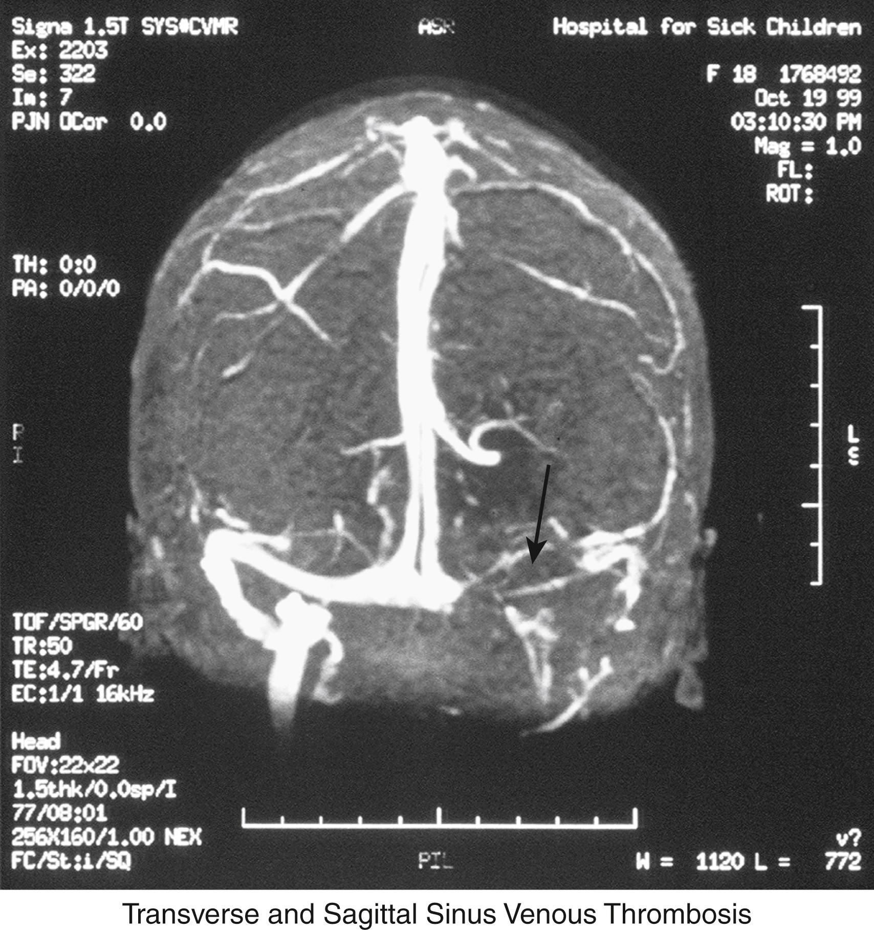 Fig. 23.18, Magnetic resonance imaging (MRI) venogram of cerebral vein thrombosis. Patient presenting with severe, unremitting headache should be investigated for a cerebral vein thrombosis. MRI venogram demonstrates occlusion of the transverse sinus.