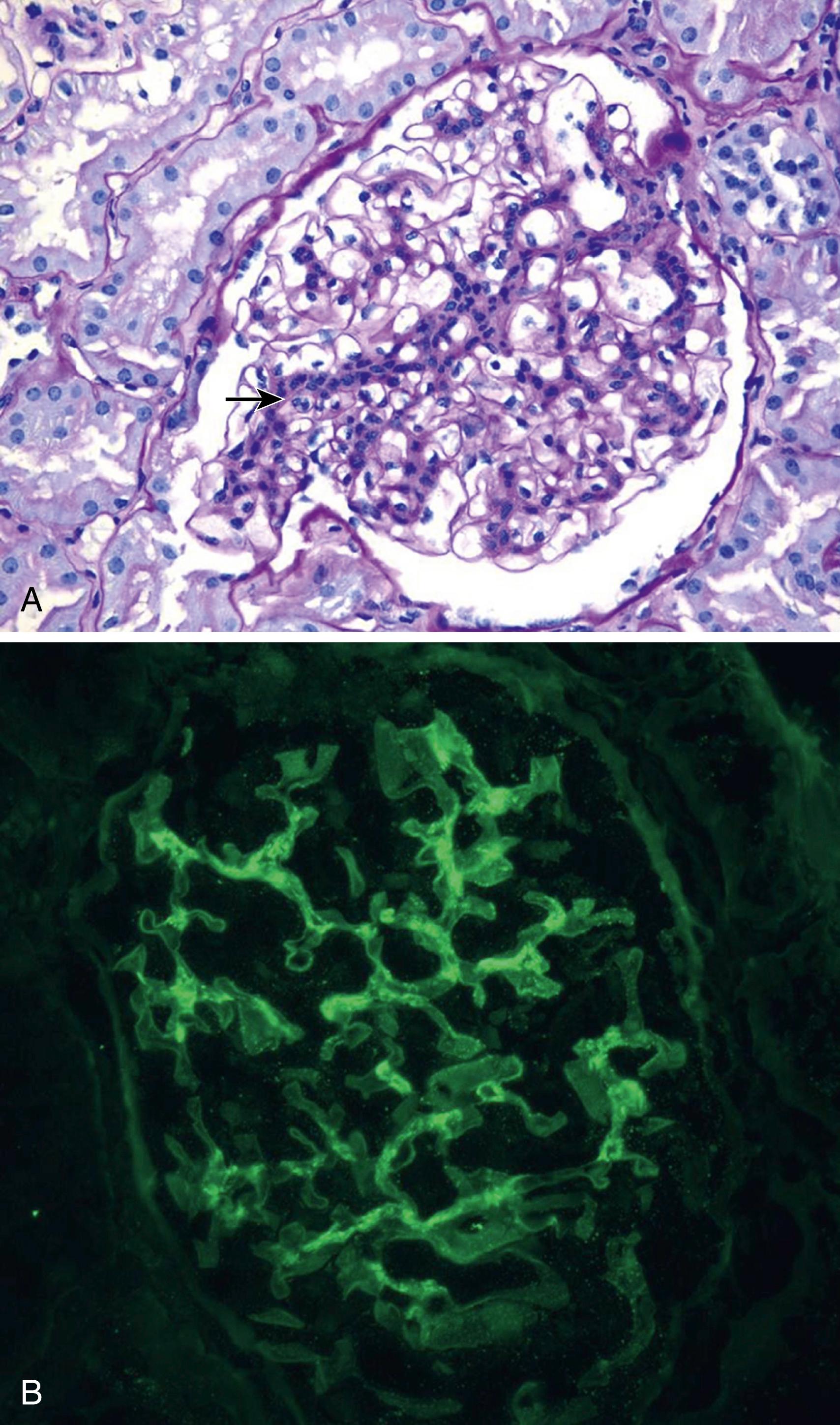 Fig. 23.4, Mesangial (class II) lupus nephritis. Representative photomicrographs of mesangial (class II) lupus nephritis, illustrating (A) mesangial proliferation ( arrow ) but open glomerular capillaries and otherwise normal appearance, periodic acid-Schiff stain, and (B) immunofluorescent staining showing a mesangial pattern of immunoglobulin (Ig)G deposition.