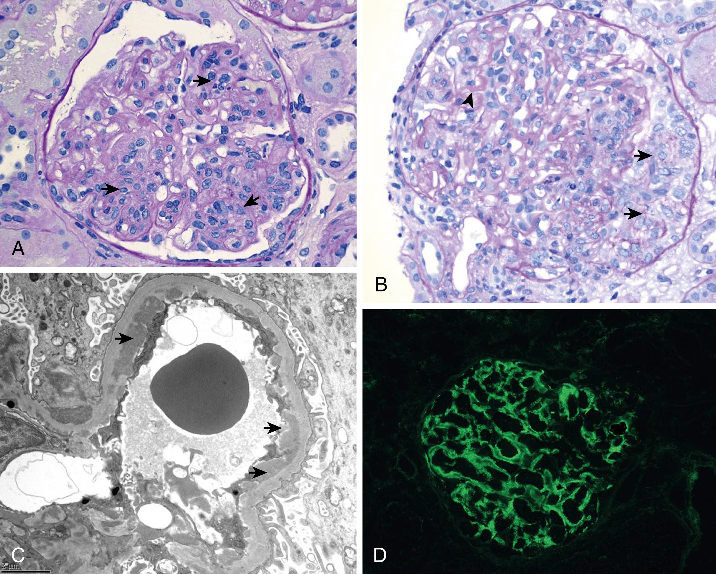 Fig. 23.5, Proliferative lupus nephritis. Representative photomicrographs of proliferative lupus nephritis. Biopsy from a patient with class IV(G)-A lupus nephritis illustrating (A) global (almost the entire glomerulus) endocapillary proliferation and exudation ( arrows ), periodic acid-Schiff stain, (B) cellular crescents from epithelial proliferation ( arrows ) and wire loops ( arrowhead ) from coalescent subendothelial immune deposits, periodic acid-Schiff stain, ( C ) electron micrograph showing numerous subendothelial ( arrows ) and mesangial electron dense deposits, and (D) immunofluorescent staining showing deposition of immunoglobulin (Ig)G in glomerular capillary walls and mesangium.