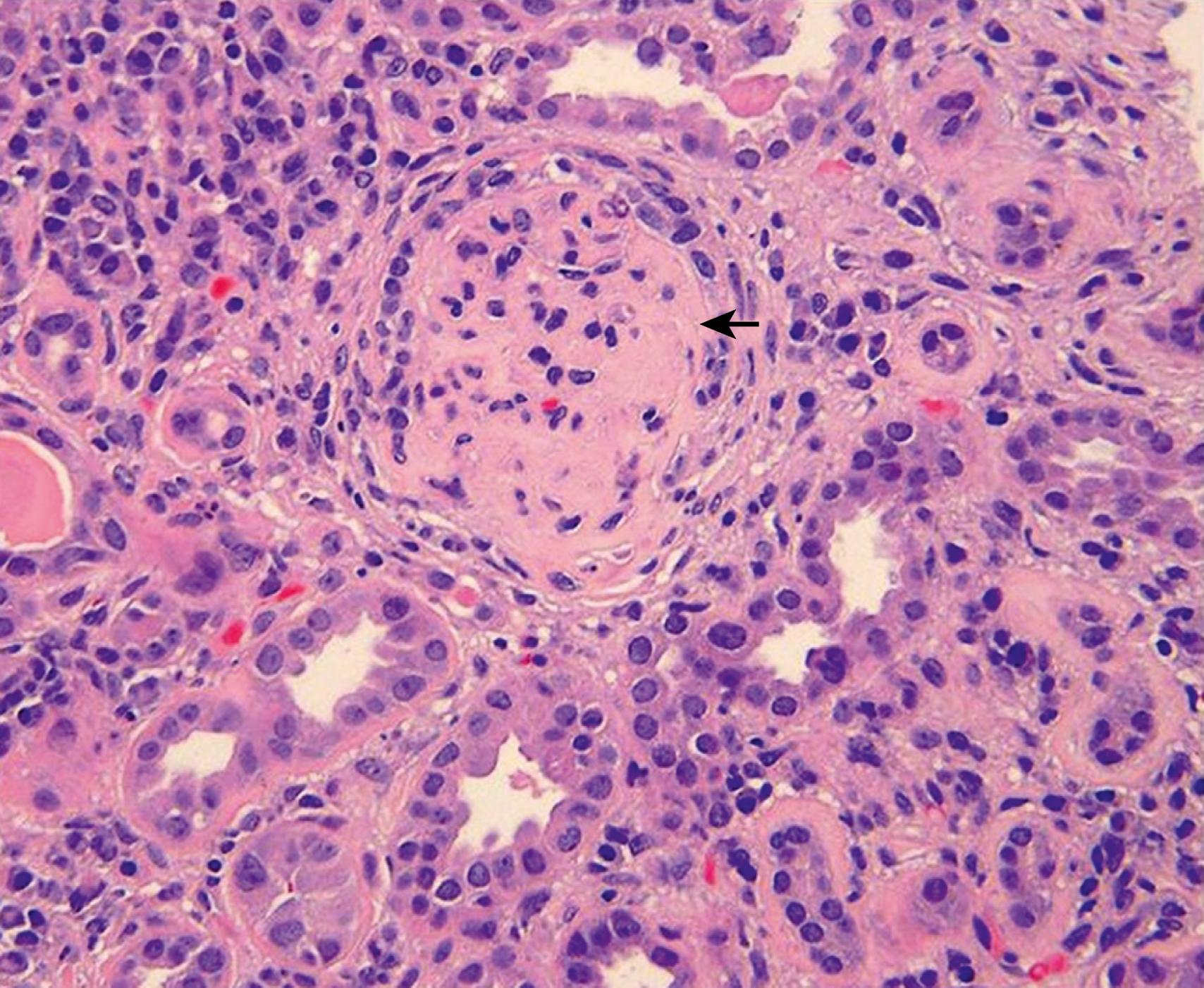 Fig. 23.7, End-stage (class VI) lupus nephritis. Representative photomicrographs of end-stage (class VI) lupus nephritis illustrating global glomerulosclerosis ( arrow ), with interstitial fibrosis, tubular atrophy, and mononuclear inflammation with numerous plasma cells, and hematoxylin and eosin stain.