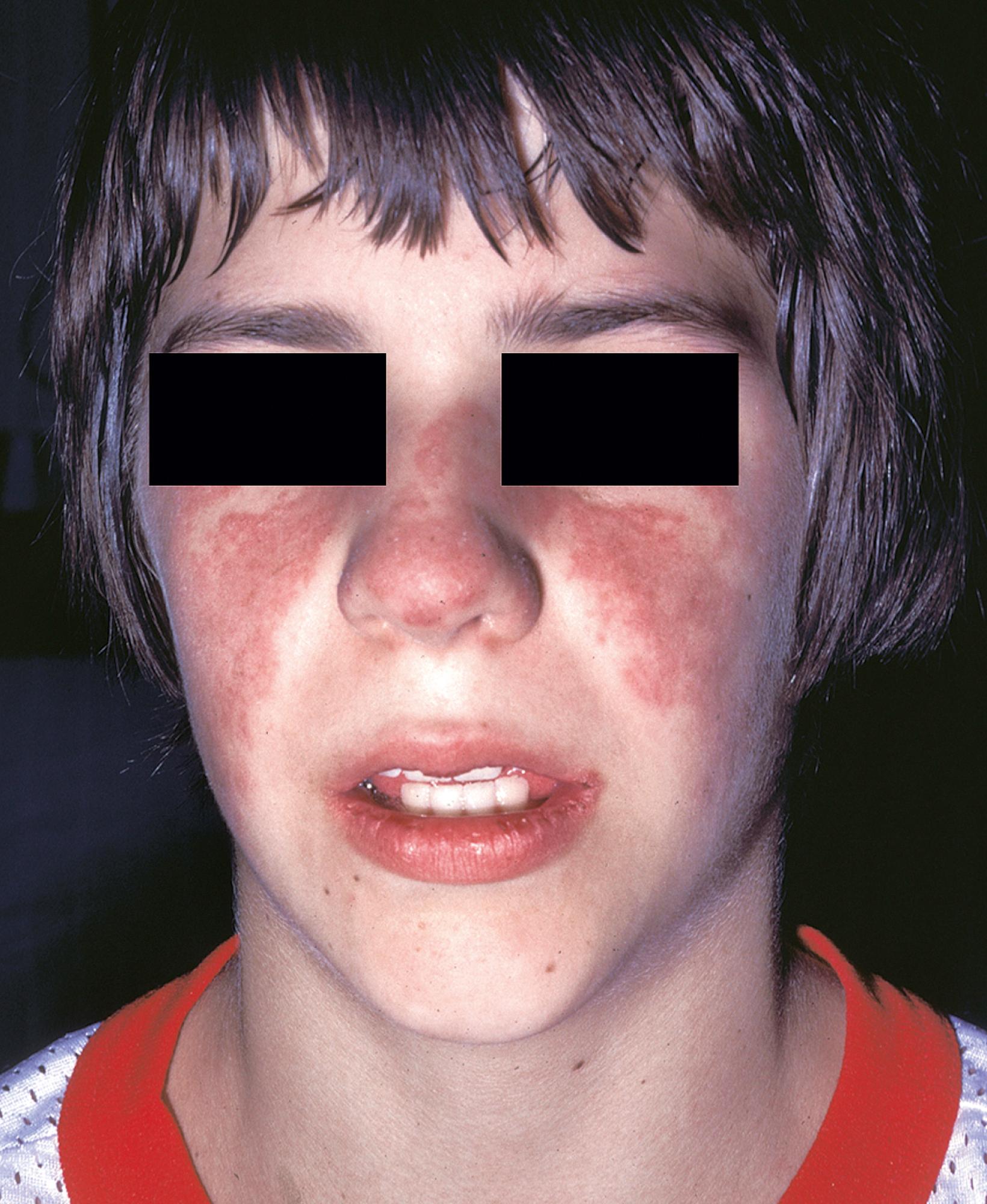 Fig. 23.9, Malar erythema of acute systemic lupus erythematosus. The classic butterfly rash has erupted over both cheeks and spread over the bridge of the nose. It may be punctate and follicular or an erythematous blush. The rash does not leave a scar.