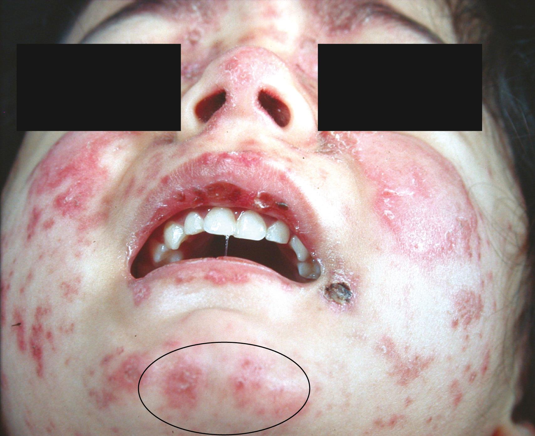 Fig. 23.10, Malar rash.