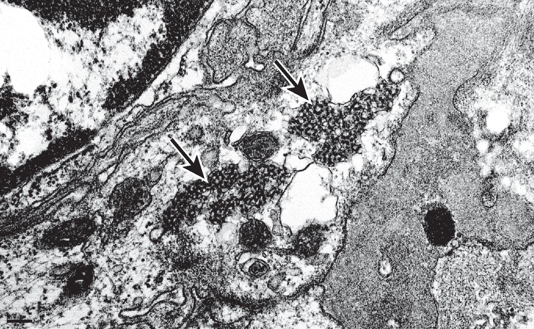 Fig. 25.1, Several large endothelial tubuloreticular inclusions (arrows) are located in dilated cisternae of the endoplasmic reticulum of this glomerular endothelial cell. These interanastomosing structures, which are commonly identified in systemic lupus erythematosus, are induced in endothelial cells by exposure to ambient interferon, earning them the name “interferon footprints” (electron micrograph, × 50,000).