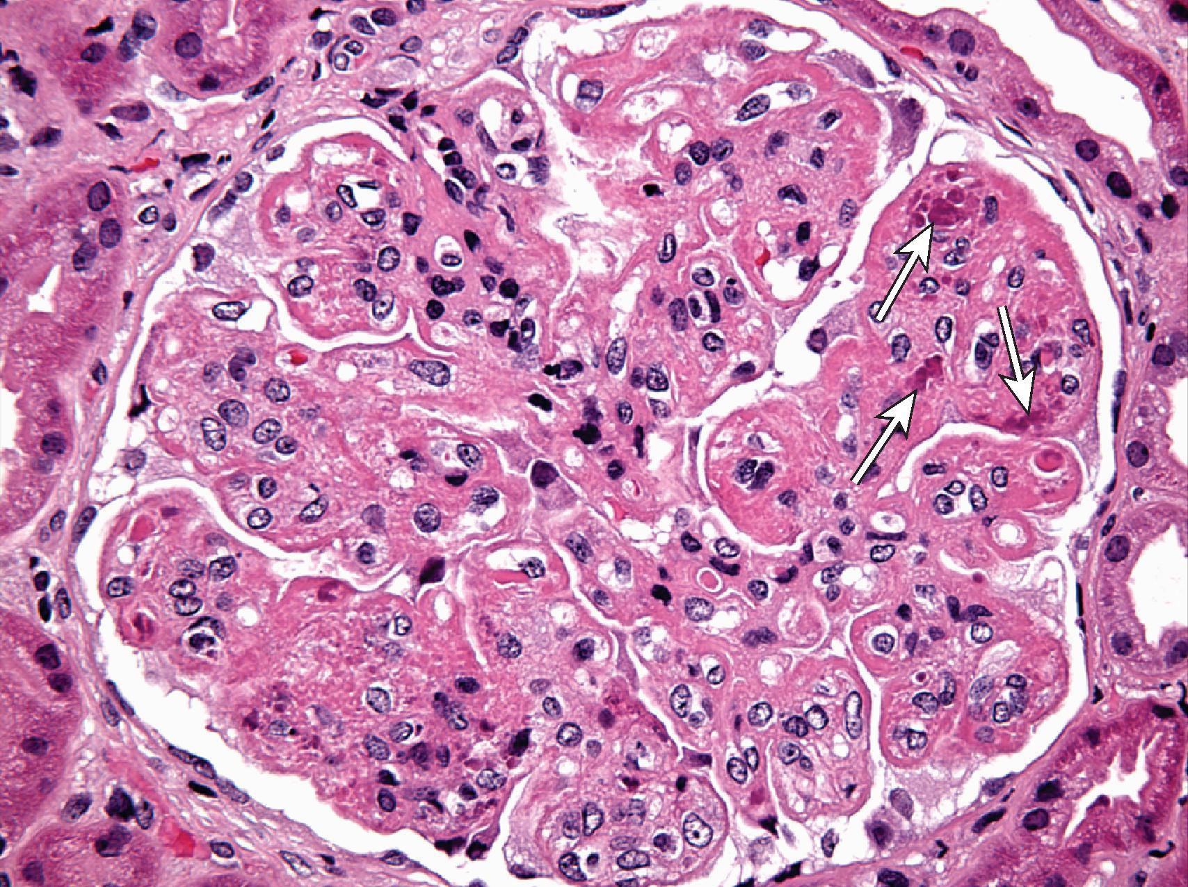 Fig. 25.2, Class IV lupus nephritis. A representative glomerulus shows global narrowing or obliteration of its capillary lumina by endocapillary hypercellularity, including infiltrating leukocytes. The glomerular capillary walls are thickened by eosinophilic material, forming wire loops. Rounded basophilic structures (“hematoxylin bodies,” arrows ) represent extruded nuclei altered by binding to antinuclear antibody (hematoxylin and eosin, ×400).