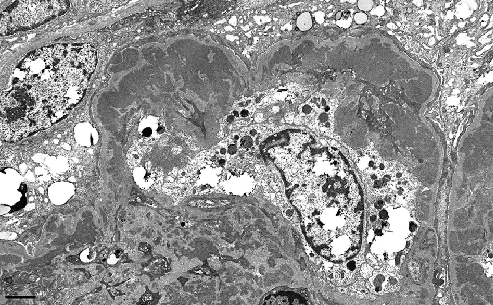 Fig. 25.3, Class IV lupus nephritis. There are large electron-dense deposits within the mesangium and in the subendothelial region. Podocyte foot processes are effaced (electron micrograph, ×6000).