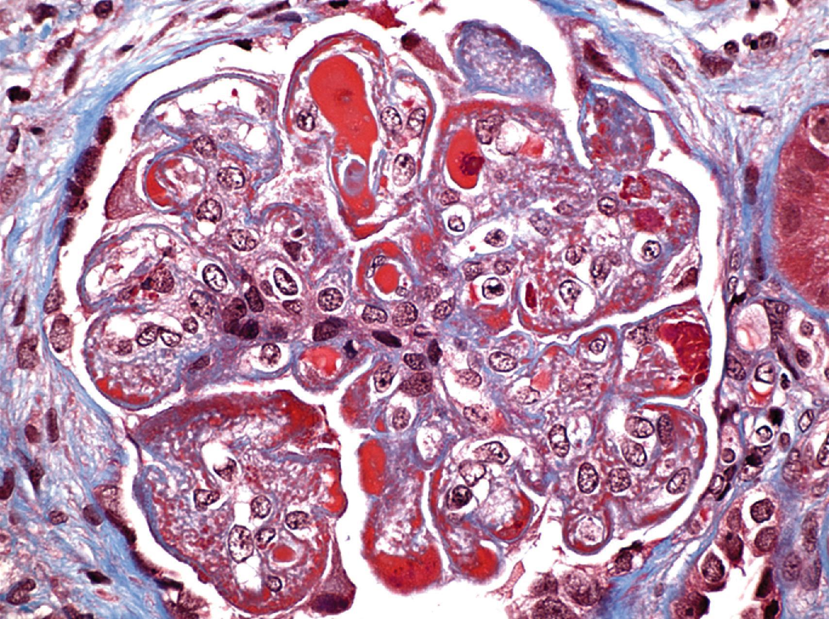 Fig. 25.4, Class IV lupus nephritis. Trichrome stain is useful to highlight fuchsinophilic (red) deposits against the blue-staining glomerular basement membrane and mesangial matrix. In this glomerulus, many subendothelial “wire loops” and intracapillary “hyaline thrombi” are seen (Masson trichrome, ×600).