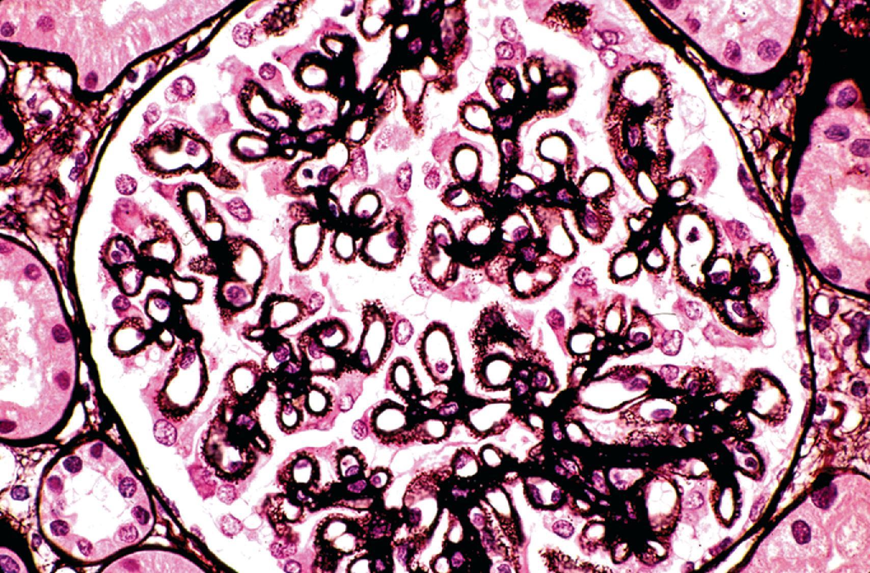 Fig. 25.5, Class V lupus nephritis. Membranous lupus nephritis has global thickening of glomerular capillary walls. Silver stain delineates the characteristic silver-positive spikes projecting from the glomerular basement membranes. These spikes form between silver-negative subepithelial deposits (Jones methenamine silver, ×600).