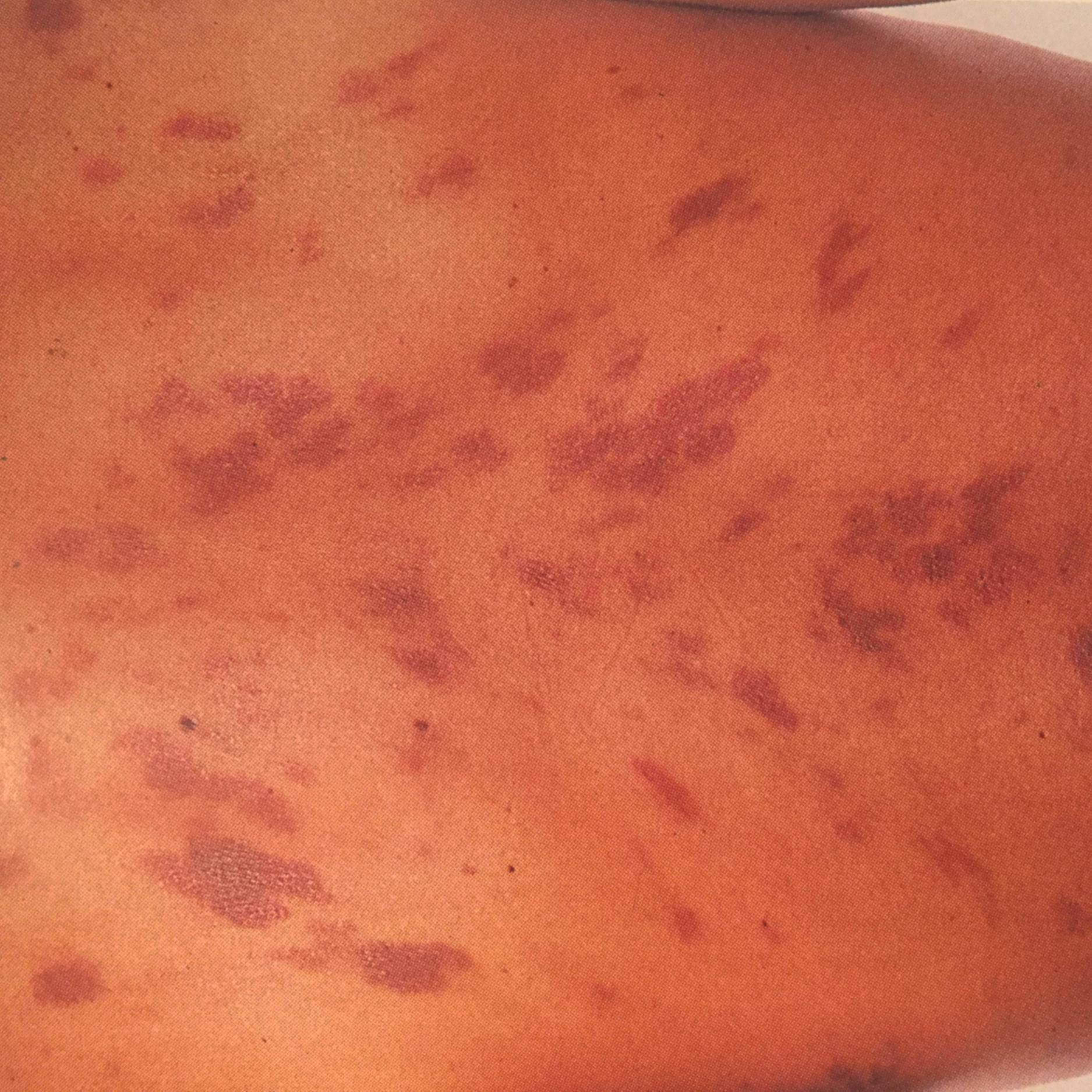 FIGURE 359-2, Cutaneous Kaposi sarcoma.