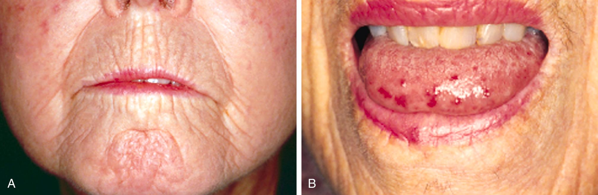 FIGURE 246-1, Facial features in systemic sclerosis.