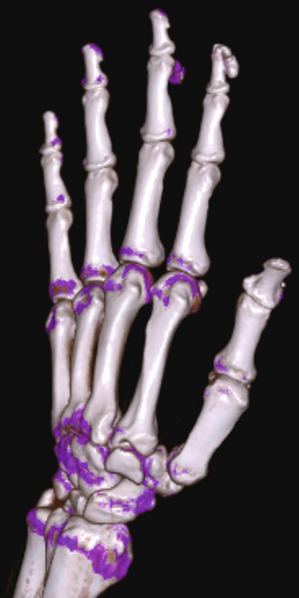 FIGURE 246-3, Calcinosis cutis in systemic sclerosis.