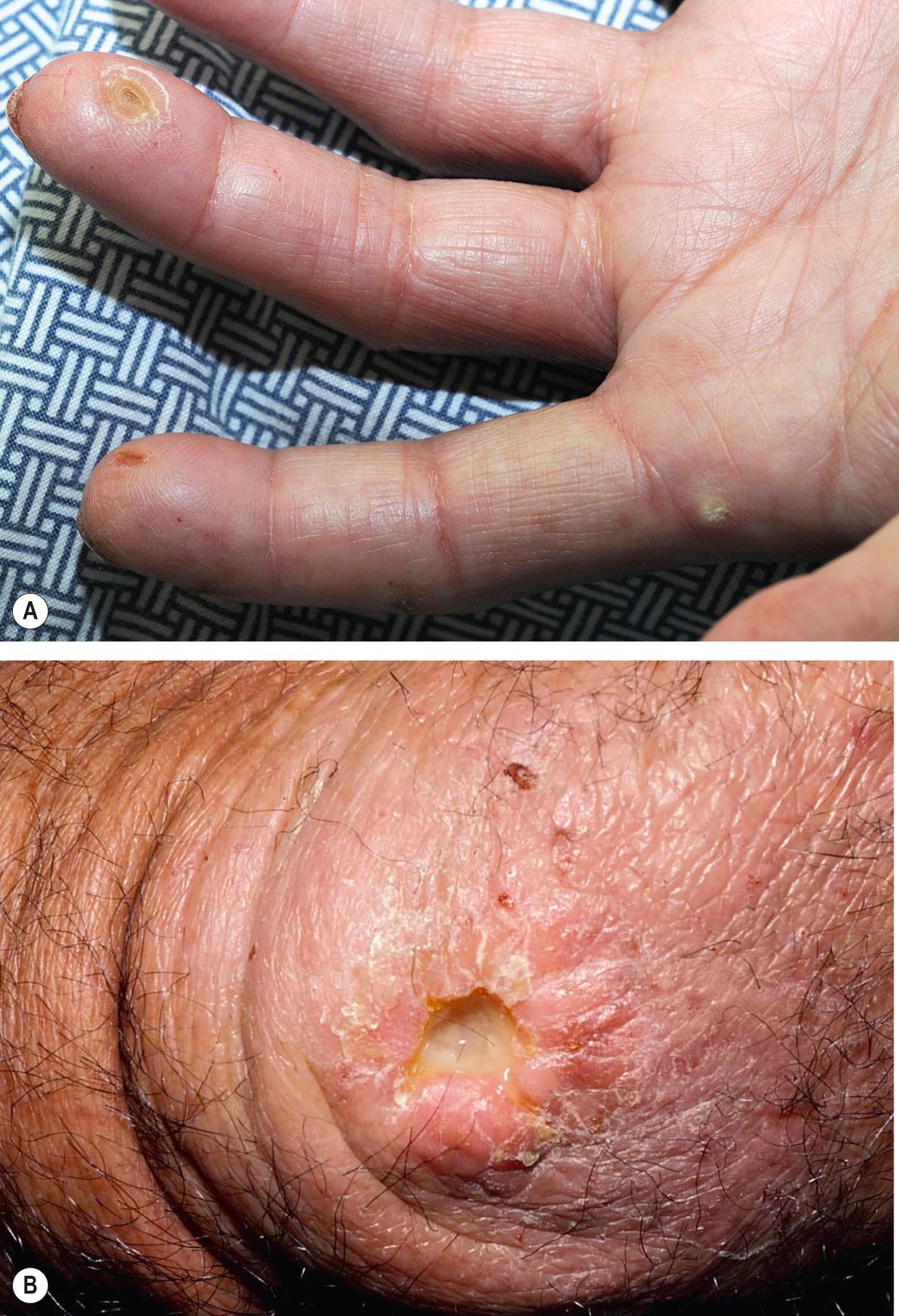 Fig. 43.11, Cutaneous ulcerations in systemic sclerosis.