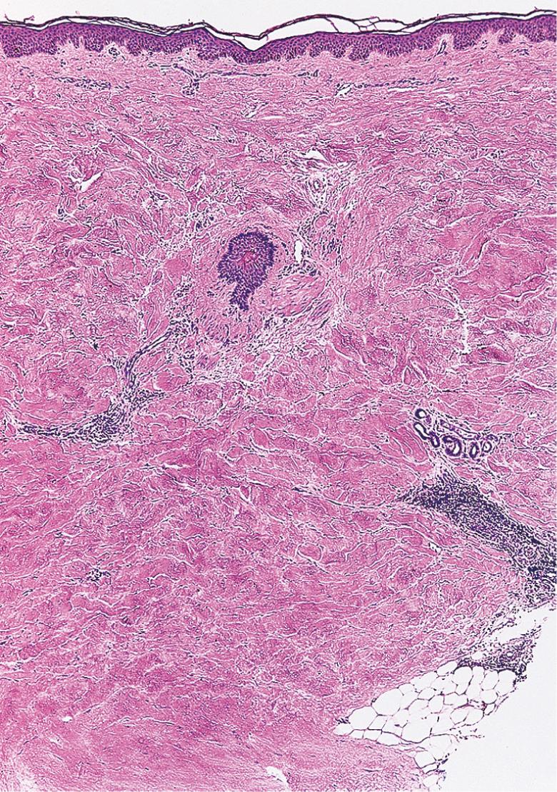 Fig. 43.12, Systemic sclerosis – histologic features.