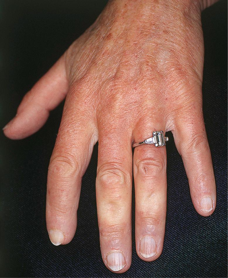 Fig. 43.3, Early, edematous phase of systemic sclerosis.