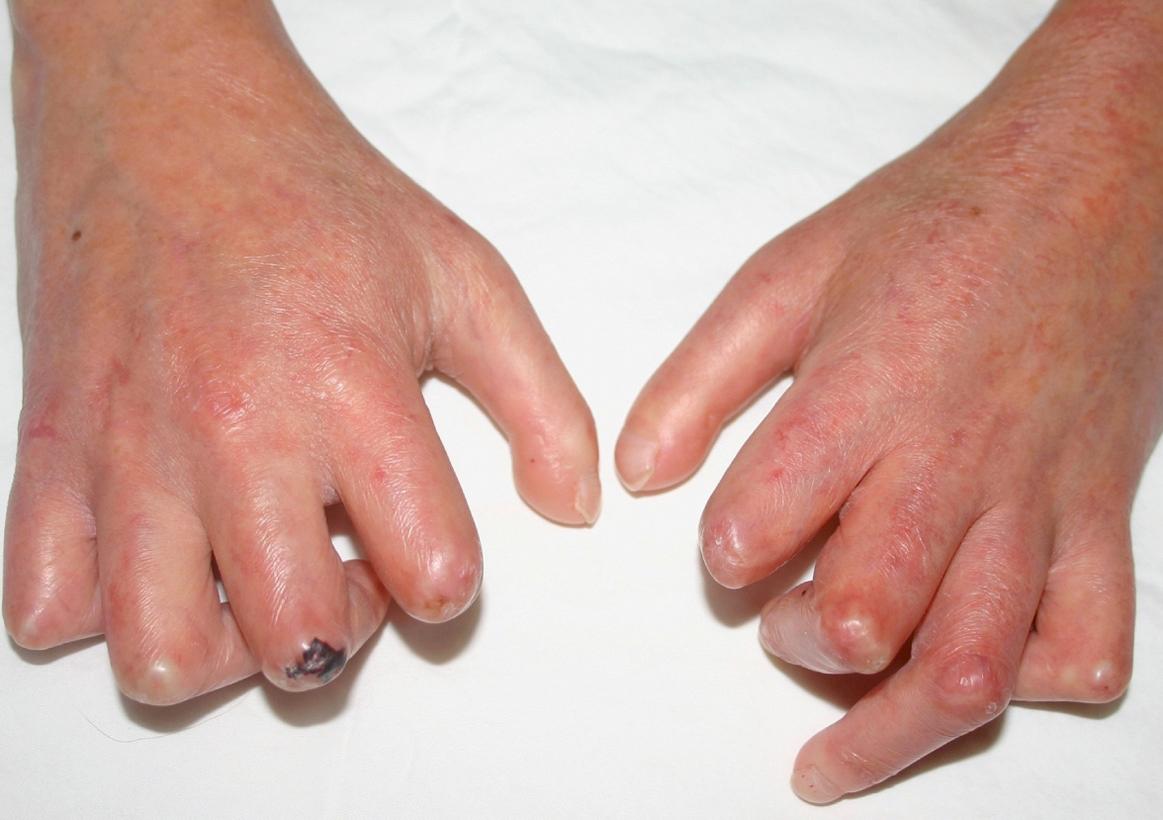 Fig. 43.5, Late stage of systemic sclerosis with diffuse cutaneous systemic sclerosis.