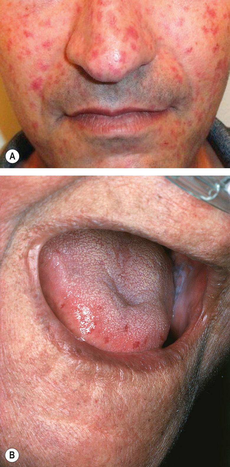 Fig. 43.7, Mat (squared-off) telangiectasias in systemic sclerosis (SSc).