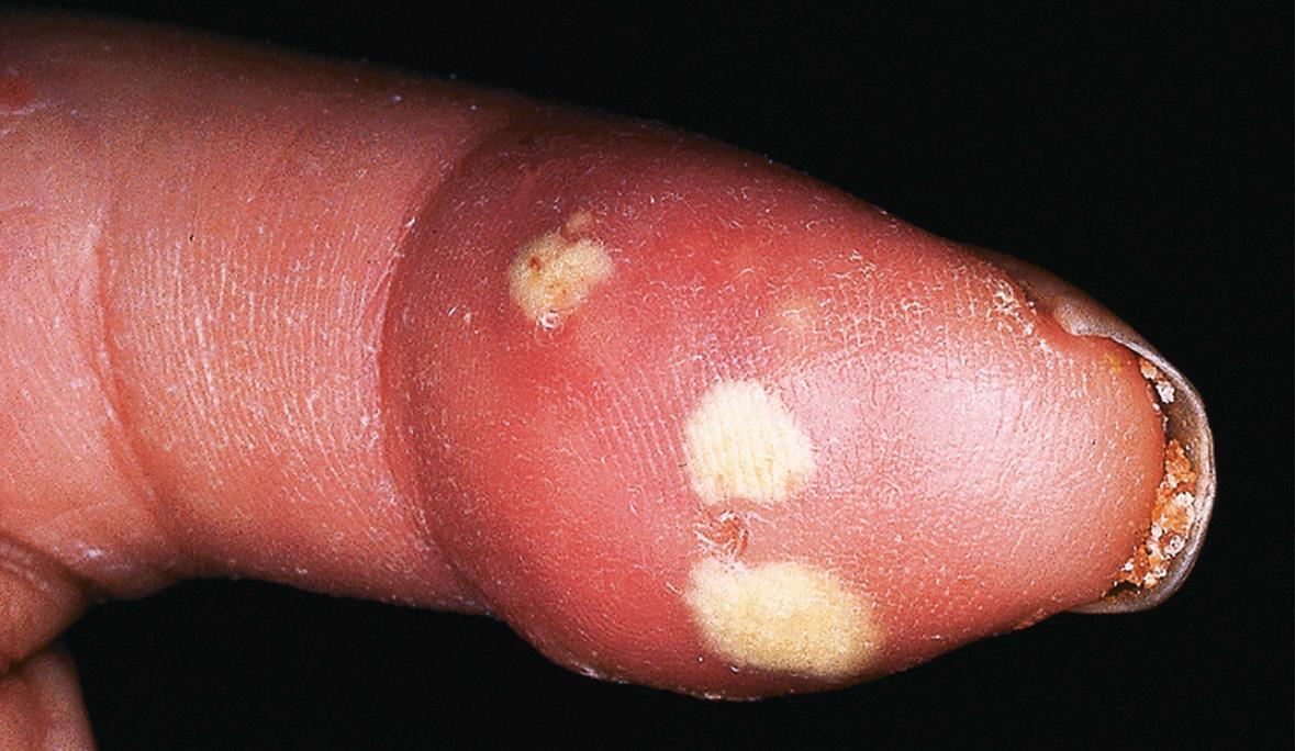 Fig. 43.8, Calcinosis cutis of the finger in a patient with systemic sclerosis.