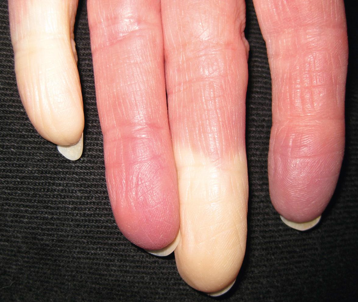 Fig. 43.9, Raynaud phenomenon in a patient with early systemic sclerosis.