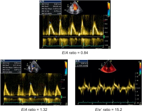 Figure 15.2, Methodology for calculating E/e' ratio. Inb the upper panel transmitral flow, in the lower panel pulsed tissue Doppler of the mitral annulus.