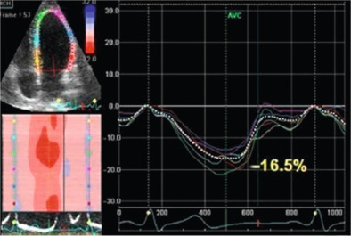 Figure 15.3, Methodology for calculating longitudinal strain. The white dotted line is the average longitudinal strain.