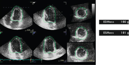 Figure 15.4, Methodology for obtaining left ventricular mass by 3D echocardiography. In agreement with the conservation of the mass, end-diastolic (ED) and end-systolic (ES) values shall be equal or, at least, very similar.