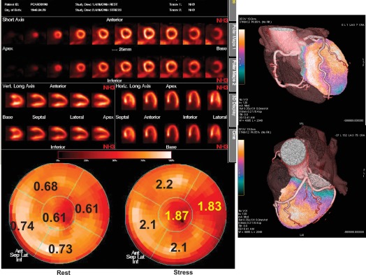 Figure 15.5, Coronary flow reserve determined by PET in a patient with normal epicardial coronary arteries.