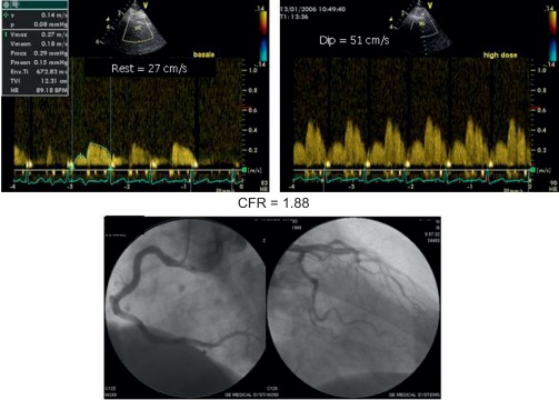 Figure 15.6, Reduced transthoracic Doppler-derived coronary flow reserve in diabetic patient with normal coronary angiography.