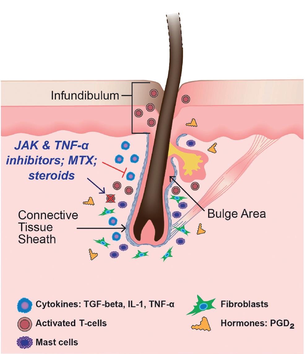 Fig. 10.1, The term “microinflammation” has been used to describe the possible inflammatory pathways present in androgenetic alopecia. Follicular microinflammation is multifactorial and involves perifollicular fibroblast activation, T-cell infiltration, prostaglandins, and mast cell degranulation. JAK, janus kinase; MTX, methotrexate; TNF-α, tumor necrosis factor alpha.