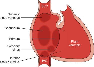 Figure 72.1, Diagram showing the types of atrial septal defects as viewed from the right atrium. IVC, Inferior vena cava; SVC, superior vena cava.