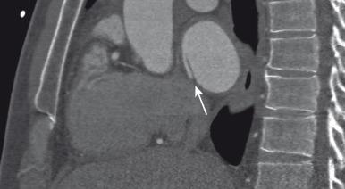 Figure 72.2, Patent foramen ovale in a teenage boy.