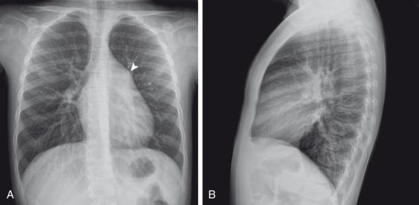 Figure 72.3, Atrial septal defect, secundum type, in a 7-year-old.