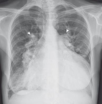 e-Figure 72.4, Atrial septal defect and pulmonary hypertension.