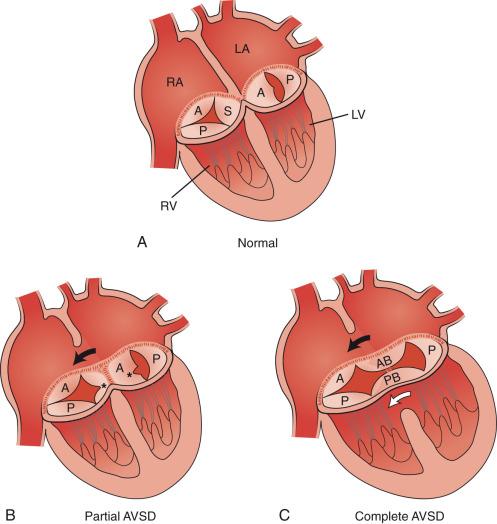 Figure 72.6, Diagrams illustrating the spectrum of atrioventricular septal defect (AVSD).