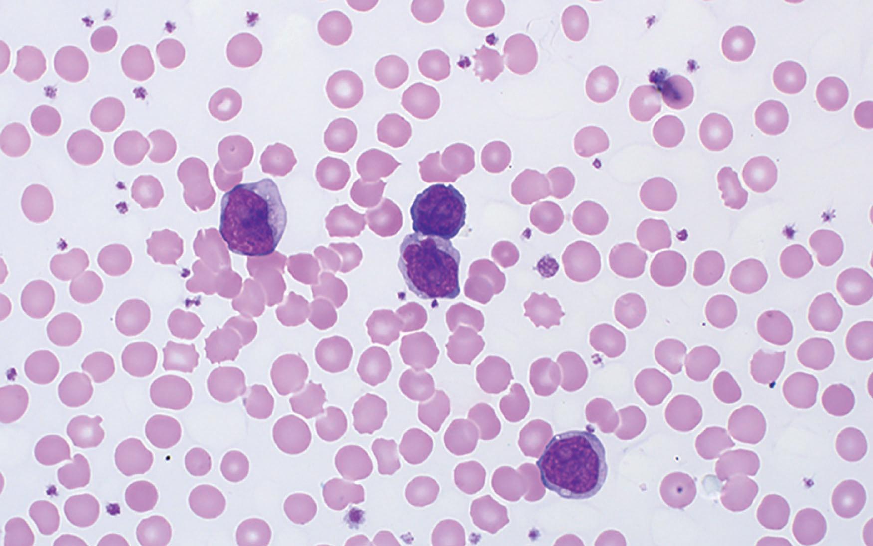 Figure 89.2, T-CELL PROLYMPHOCYTIC LEUKEMIA, PERIPHERAL BLOOD SMEAR.