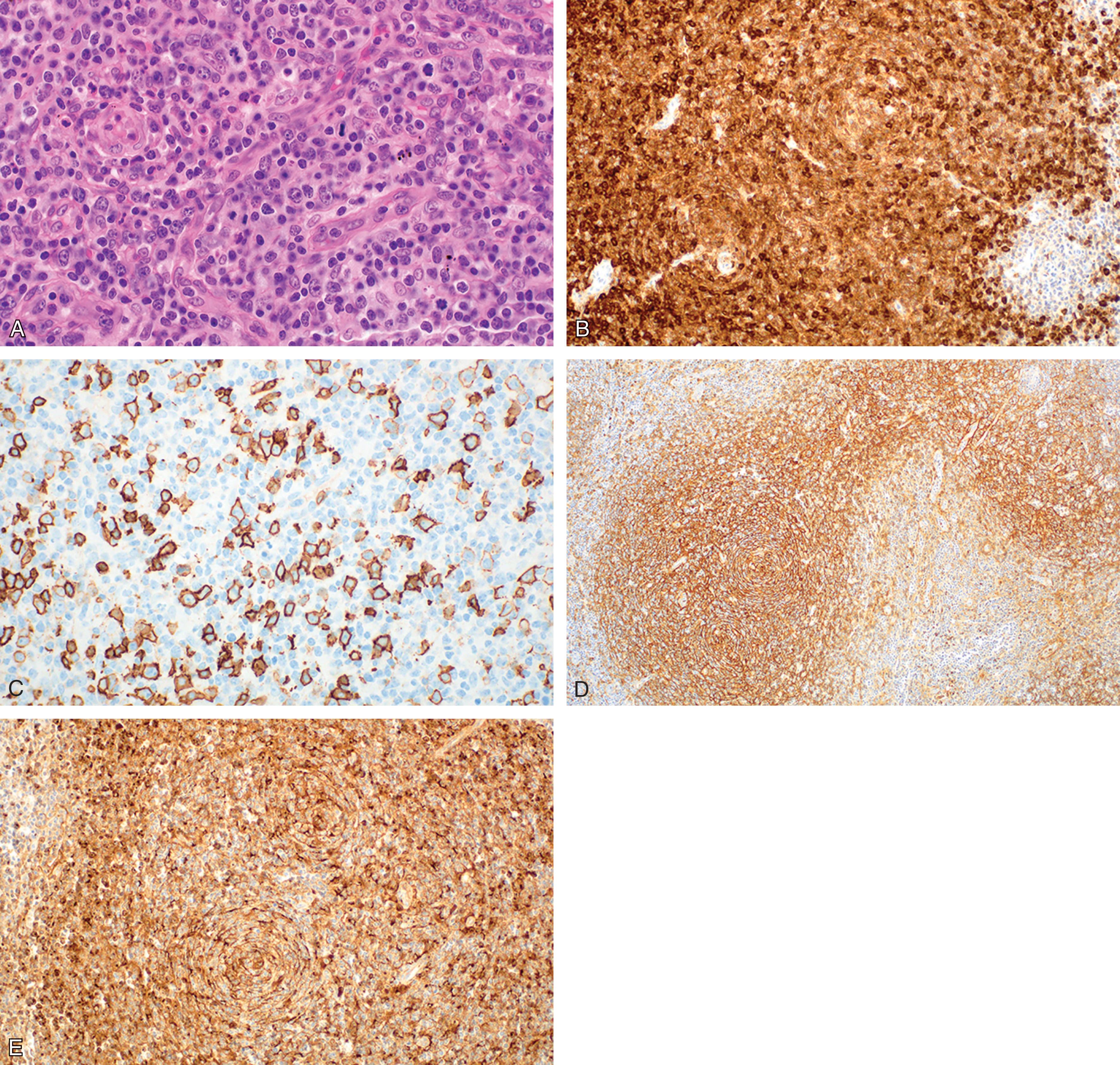 Figure 89.4, Angioimmunoblastic T-cell lymphoma, lymph node biopsy, hematoxylin-eosin staining (panel A). Positive immunostaining for CD10 (panel B). Immunohistochemistry for CD20 reveals several scattered B cells (panel C). Follicular dendritic cell meshwork highlighted with CD21 immunostaining (panel D). The immunohistochemical expression of CXCL13 on neoplastic elements suggest their derivation from T FH elements (panel E).