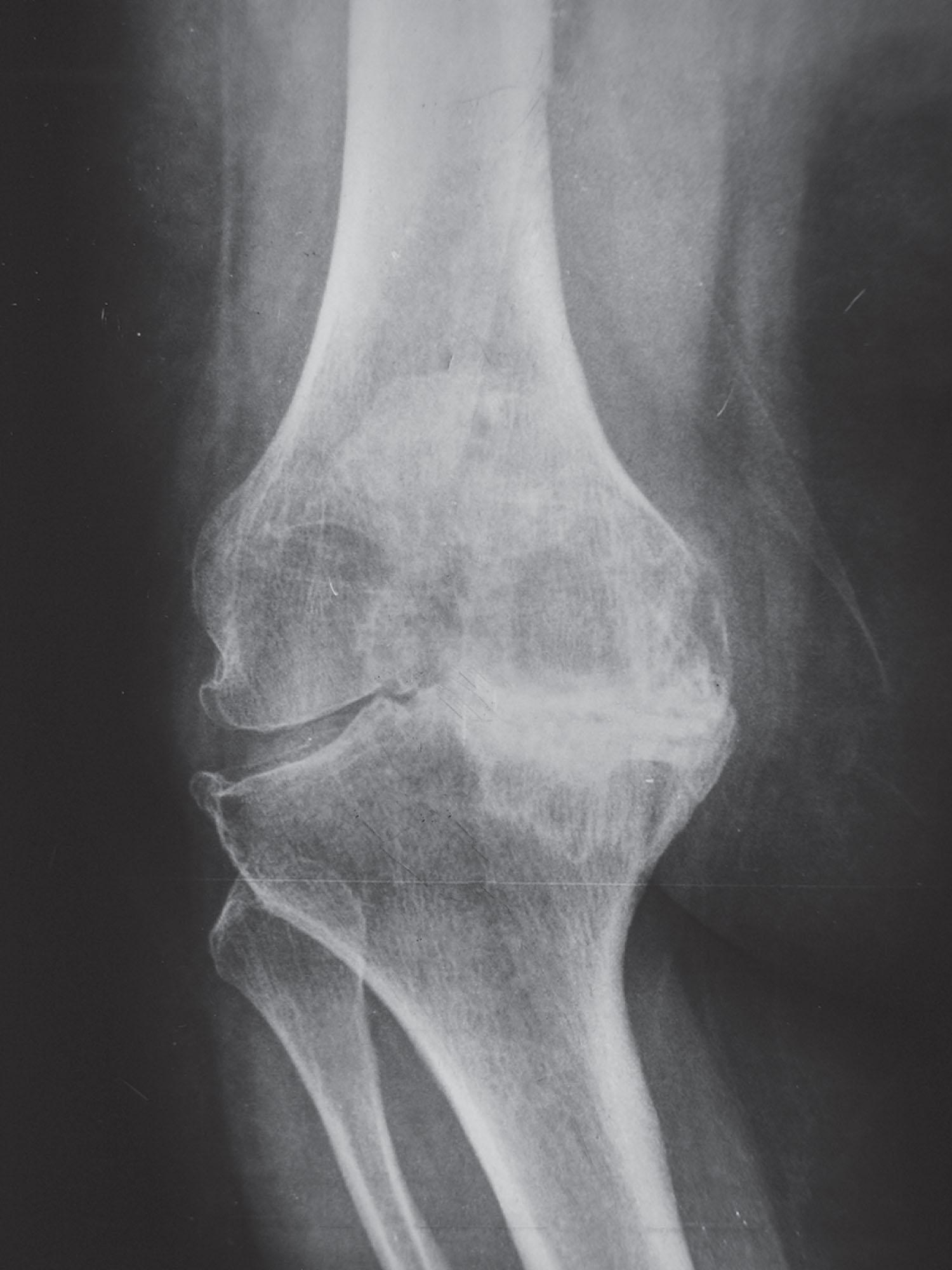 Fig. 9.12, Radiograph displays marked posteromedial reactive bone remodeling.