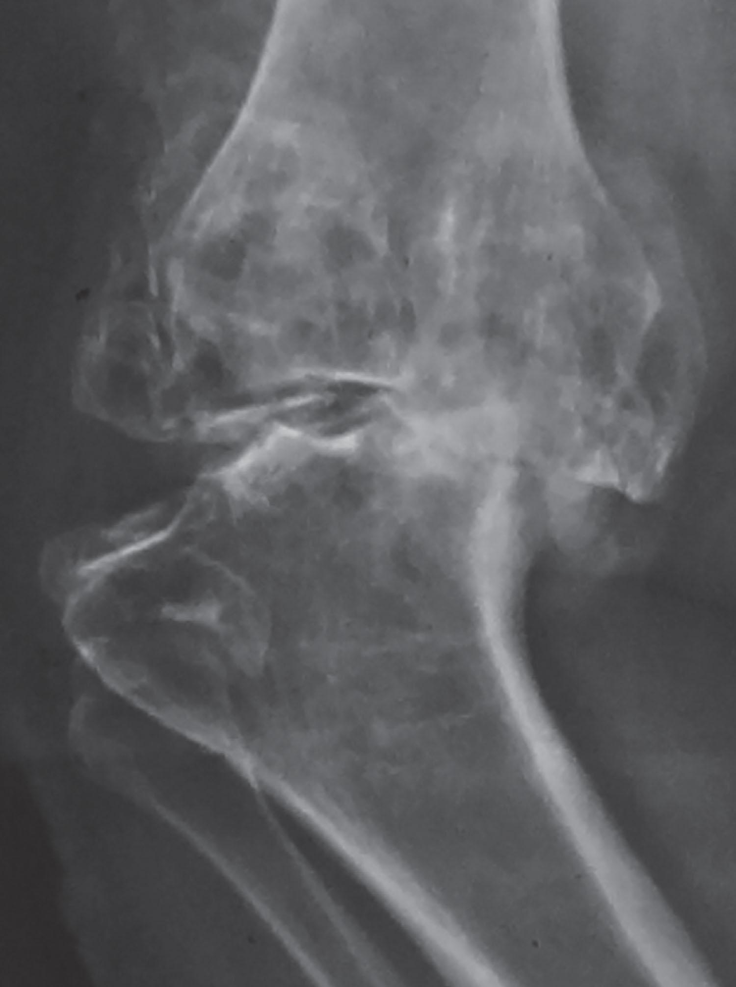 Fig. 9.13, Severe stretching of lateral structures and tibial subluxation.