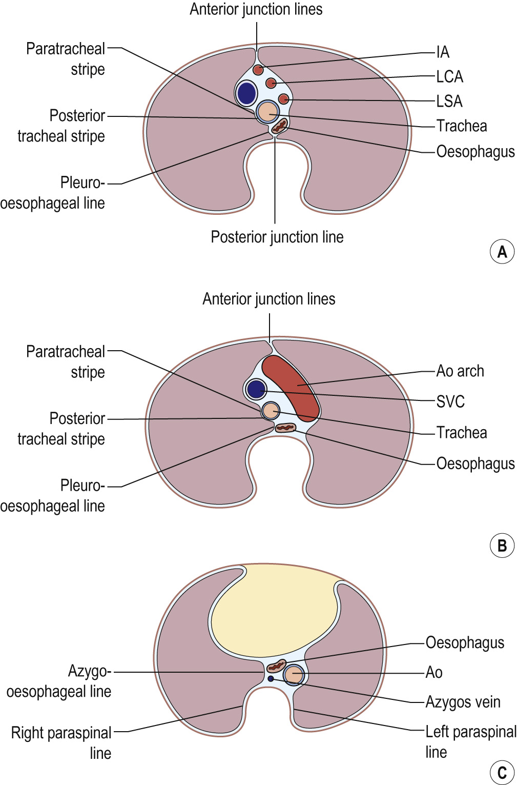 Diagrams illustrating the mediastinal boundaries and junction lines. The visualisation of the junction lines on a plain chest radiograph is variable, depending on how much fat is present in the mediastinum and on how closely the two lungs approximate to one another. (A) Section just above the level of the aortic arch. (B) Section through the aortic arch. (C) Section through the heart. **