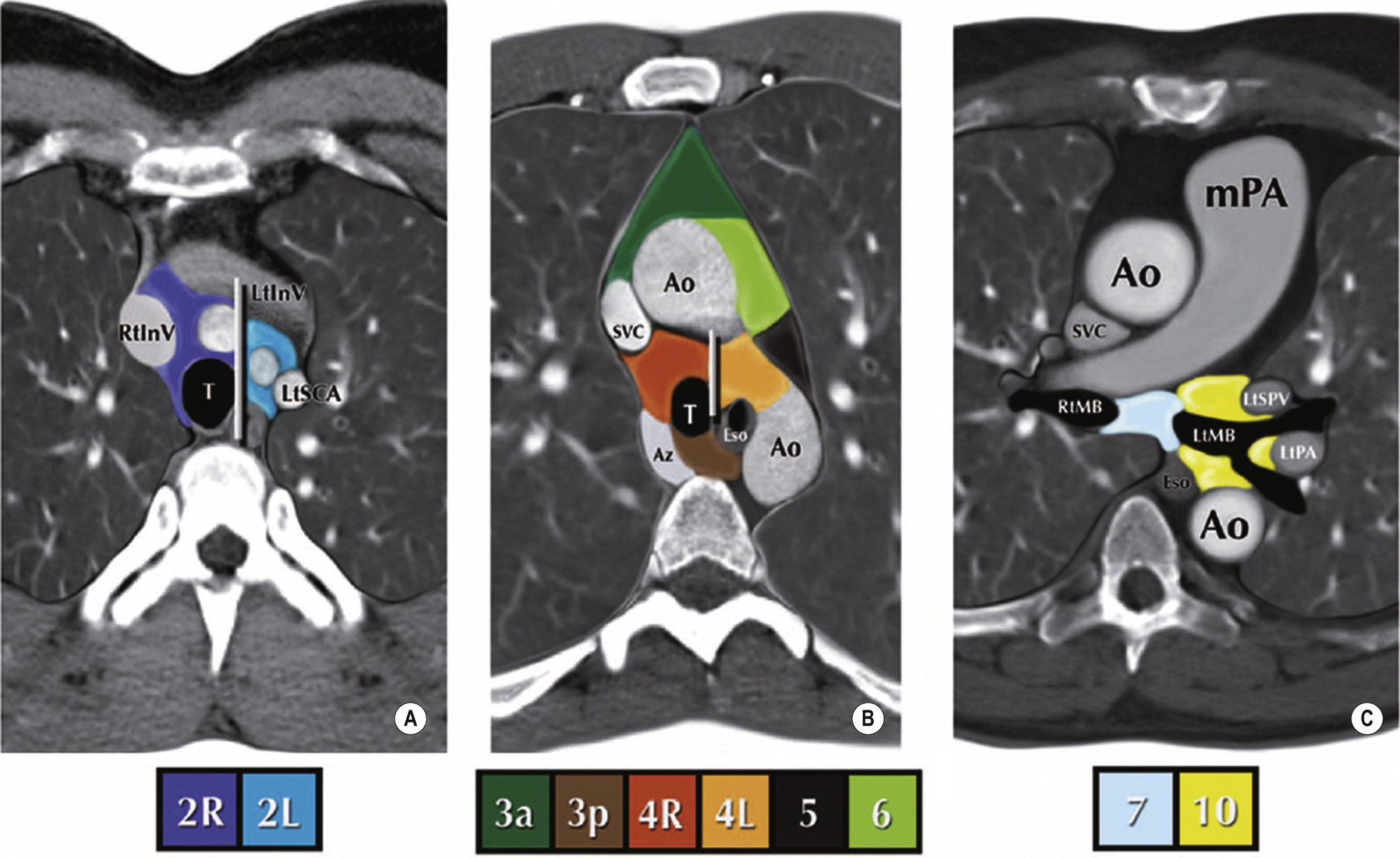 The IASLC lymph node map can be applied to clinical staging by computed tomography in axial (A–C) views. The border between the right and left paratracheal region is shown in (A) and (B). Ao = aorta; Az = azygos vein; MB = main bronchus; Eso = oesophagus; IV = innominate vein; LtInV = left innominate vein; LtSCA = left subclavian artery; PA = pulmonary artery; SPV = superior pulmonary vein; RtInV = right innominate vein; SVC = superior vena cava; T = trachea. **