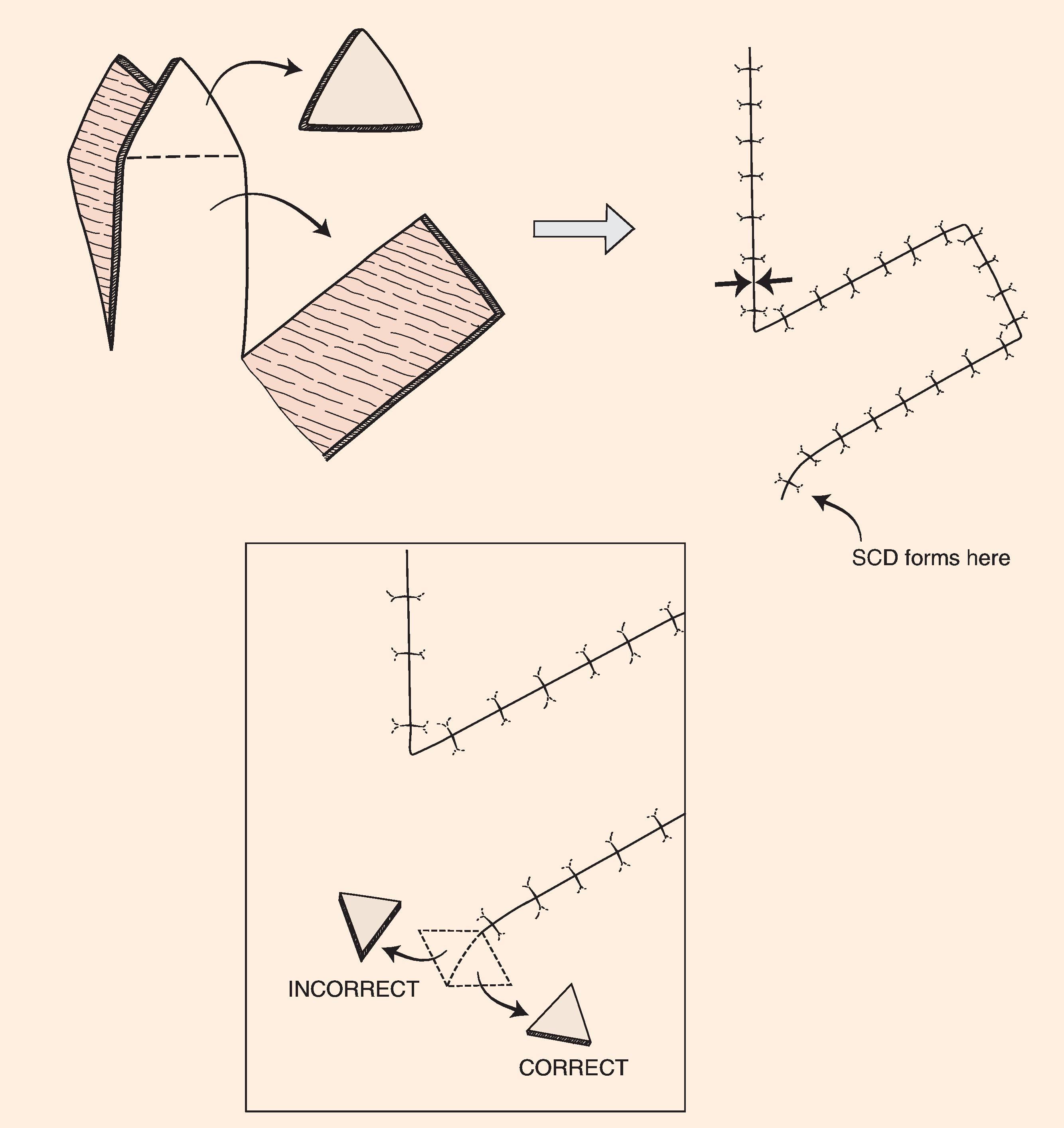 FIG. 8.2, Transposition flaps are pivotal flaps that form single standing cutaneous deformities (SCDs) at base of flap. Only base of flap must be contiguous with defect. Excision of SCD should always be in the vector that diverges from the base of flap to minimize impairment of blood supply. Opposing arrows indicate area of greatest wound closure tension.