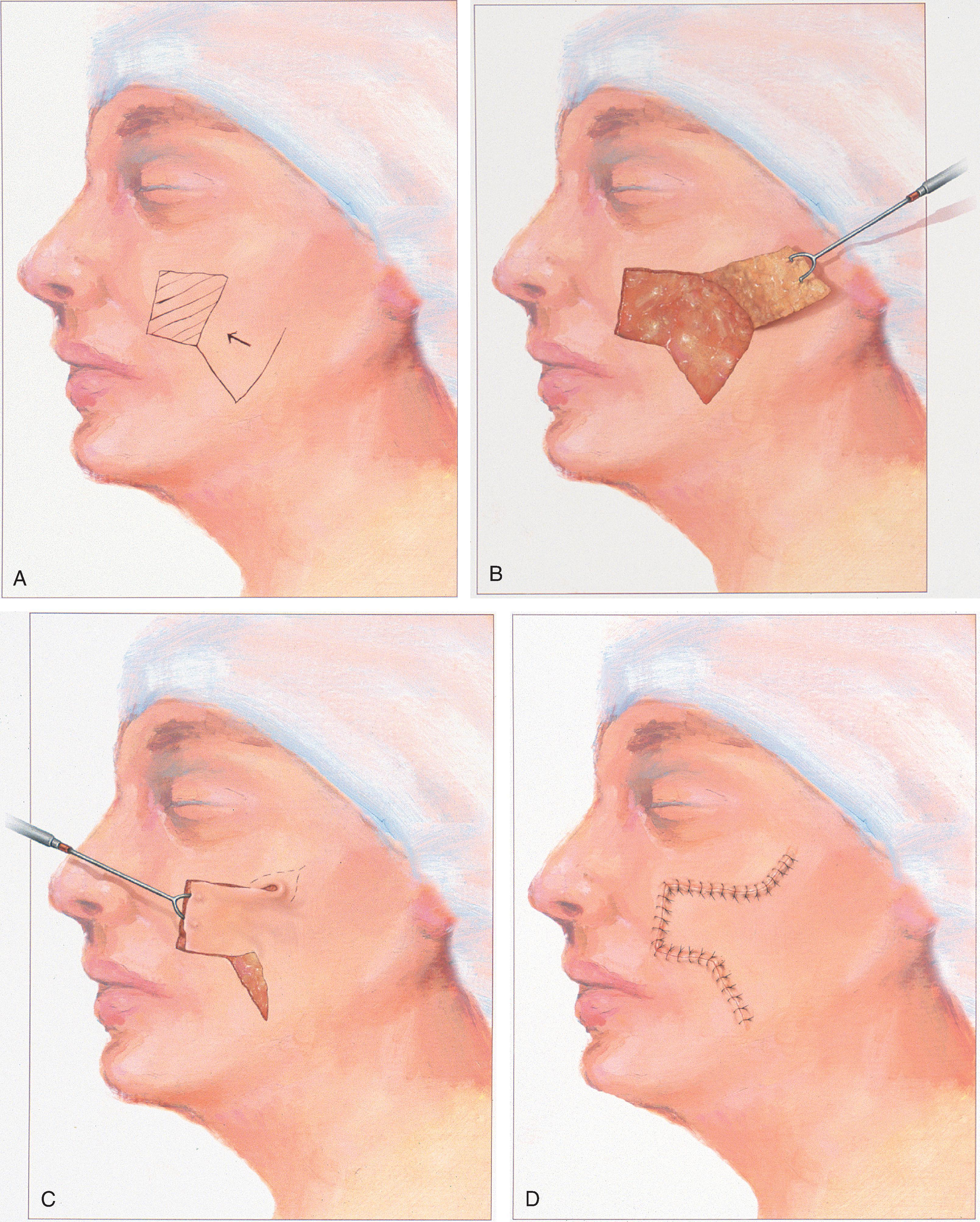 FIG. 8.3, A–D , Rectangle-shaped transposition flaps most frequently used for repair of cutaneous defects of medial and lateral cheek.