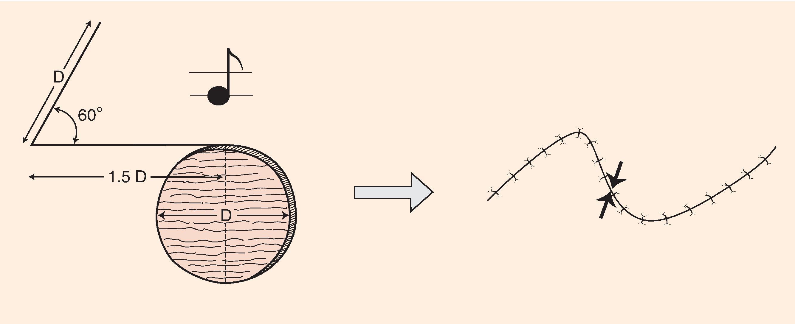 FIG. 8.4, Note flap, together with shape of defect, has configuration of musical eighth note. Note flap used for repair of circular skin defects 2 cm or less in size. One side of flap drawn parallel to relaxed skin tension lines and tangent to defect has length of 1.5 times diameter (D) of defect. Second side of triangular-shaped flap forms 50° to 60° angle with first side and is length of diameter of defect. Point of greatest wound closure tension indicated by opposing arrows.