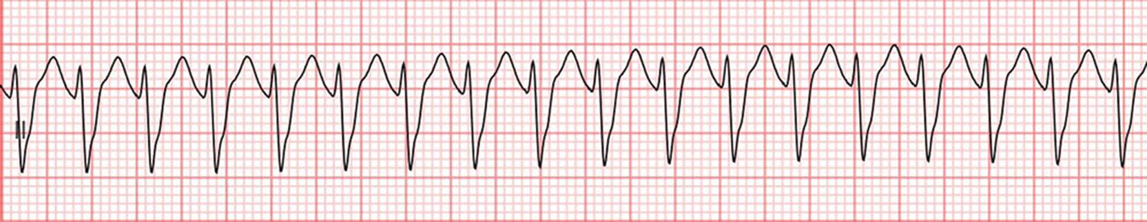 Fig. 5.1, Telemetry strip showing wide complex, monomorphic tachycardia.