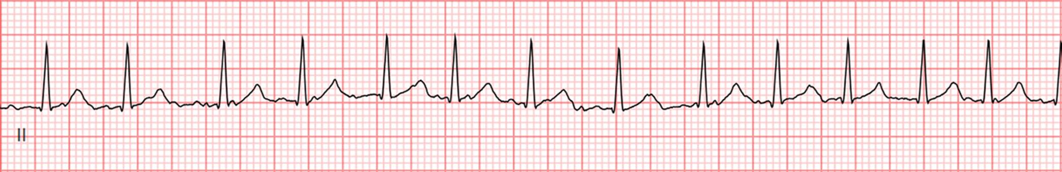 Fig. 59.1, Telemetry strip showing irregularly irregular rhythm with a ventricular rate of 140 bpm.