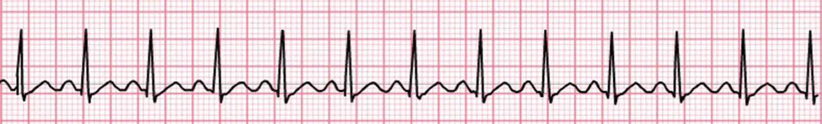 Fig. 7.1, Telemetry strip showing regular, narrow complex tachycardia with identifiable P waves consistent with sinus tachycardia.