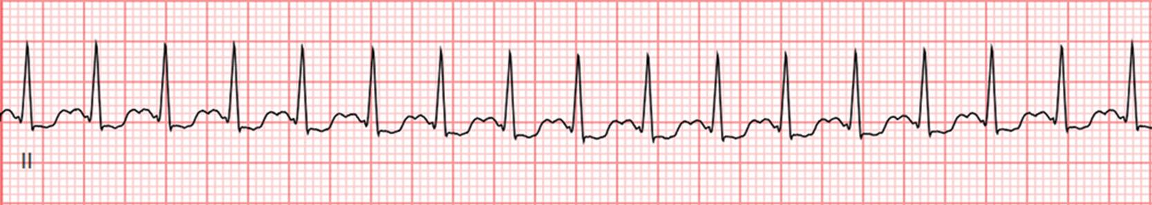 Fig. 19.1, Cardiac rhythm strip showing sinus tachycardia at a rate of ~180 beats per min, with ST-segment depression.