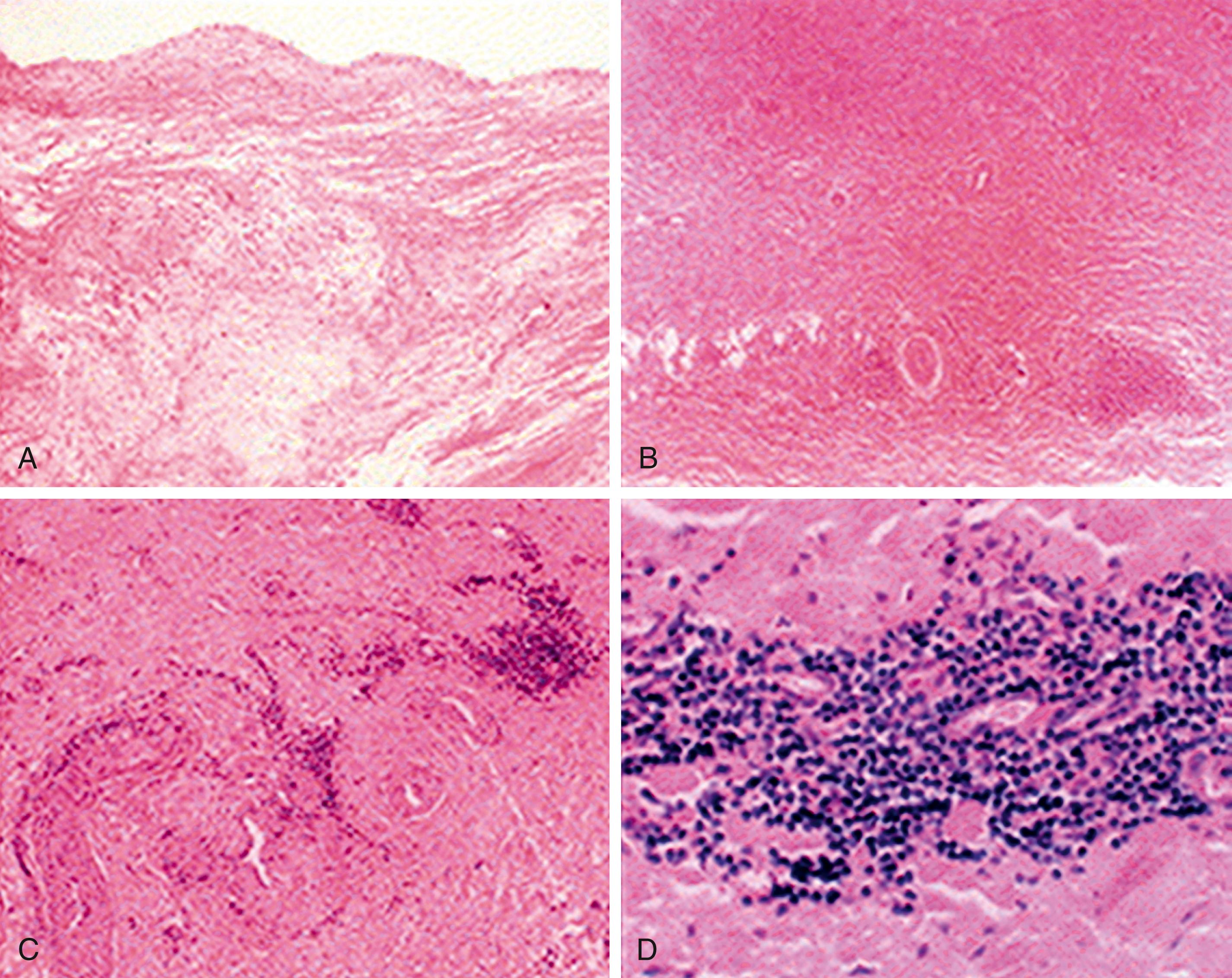 Figure 140.1, Histologic Findings in Takayasu Arteritis.