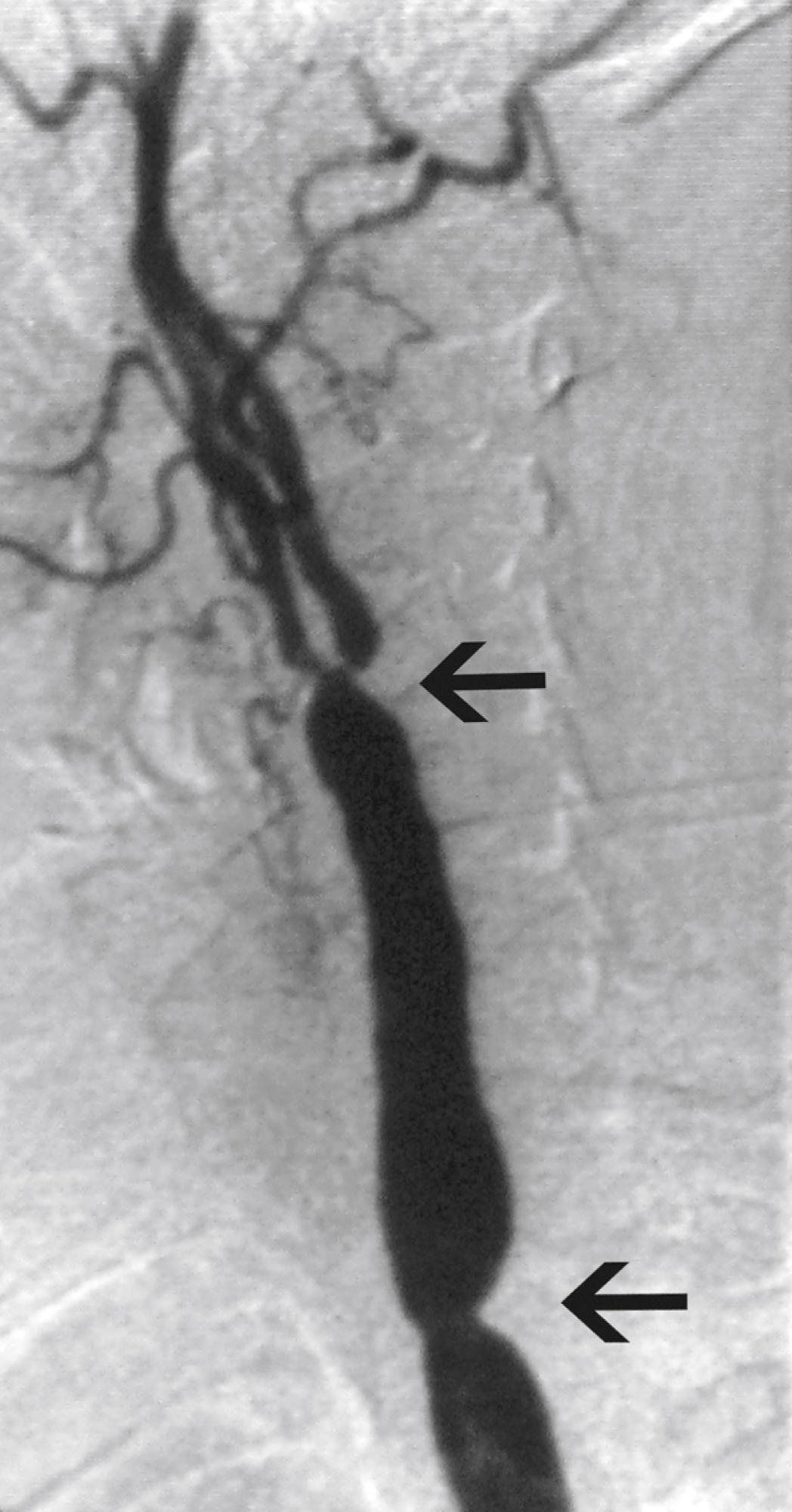 Figure 140.2, Selective carotid angiogram of a 34-year-old woman with symptoms of cerebral ischemia. Note the stenoses of both the common carotid artery and the carotid bifurcation (arrows) .