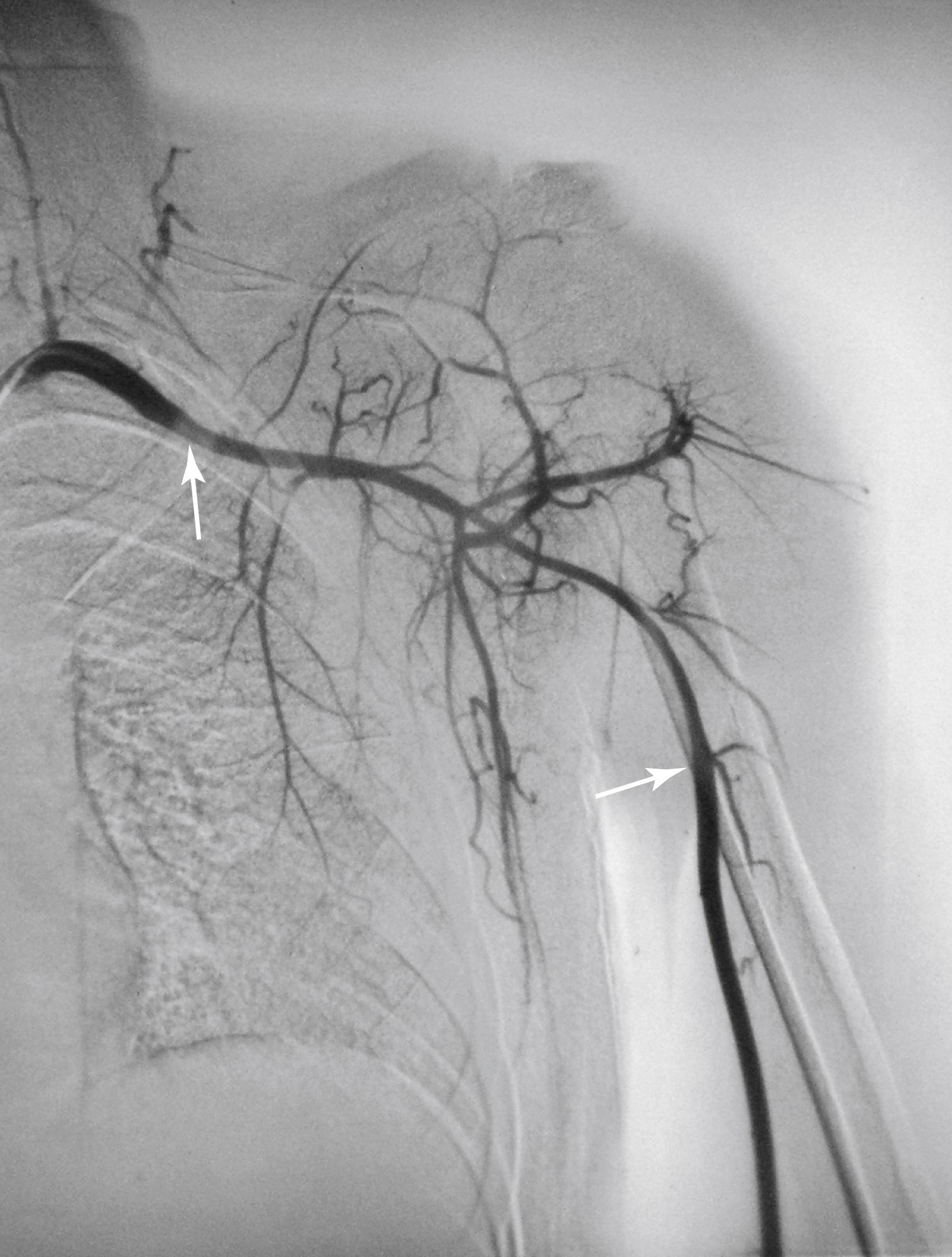 Figure 140.3, Selective left subclavian angiogram of a 26-year-old woman with claudication of the left upper extremity. Note the long, tapered stenosis of the left subclavian and axillary arteries ( arrows ).