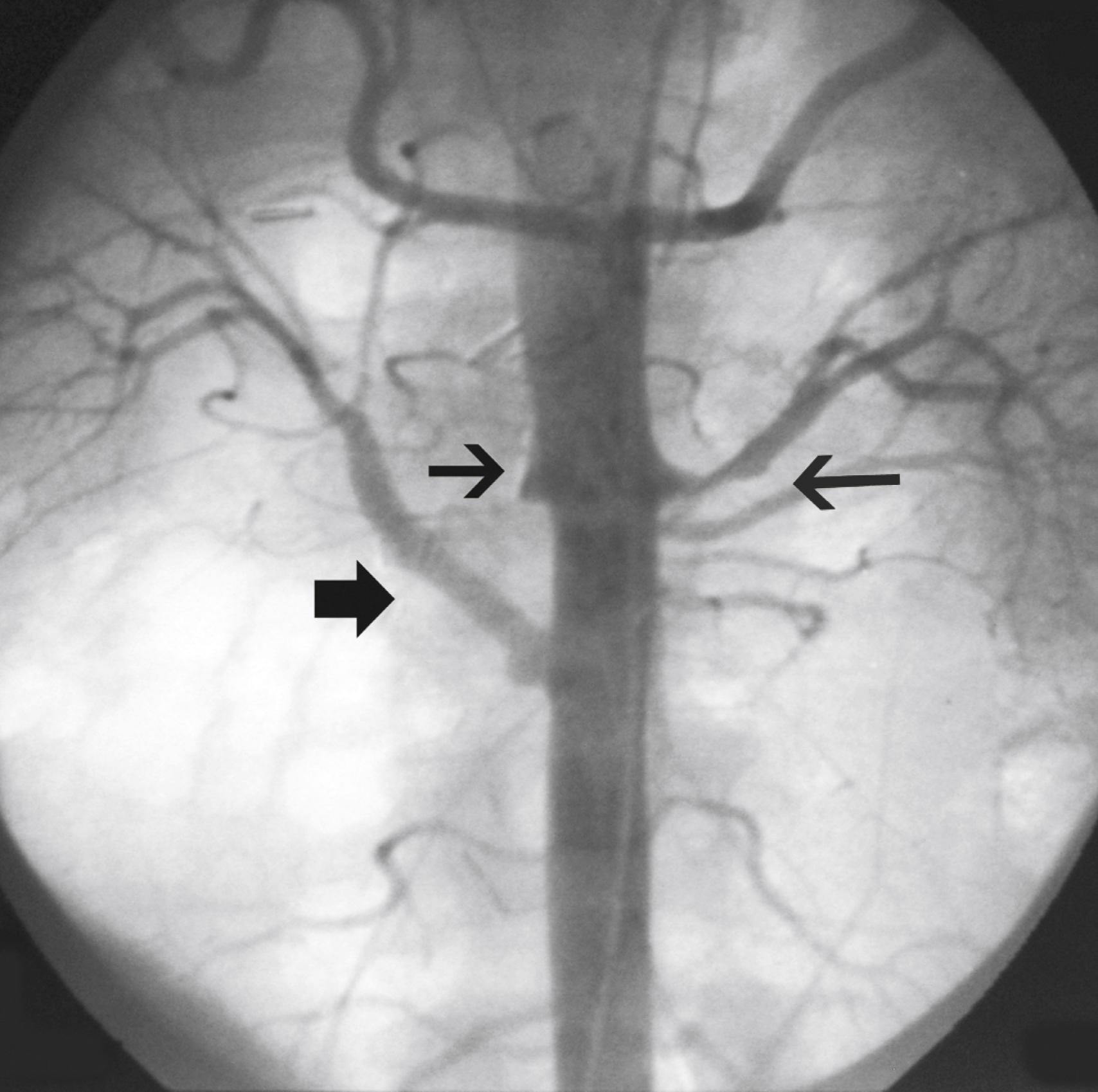 Figure 140.4, Abdominal aortogram of a 48-year-old hypertensive woman with known Takayasu arteritis. Note the short-segment left renal artery stenosis (long arrow), right renal artery occlusion (small arrow), and right aortorenal artery bypass (broad arrow) .